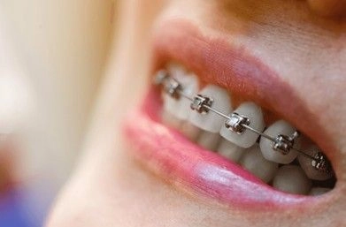 Self-Ligating Braces Singapore