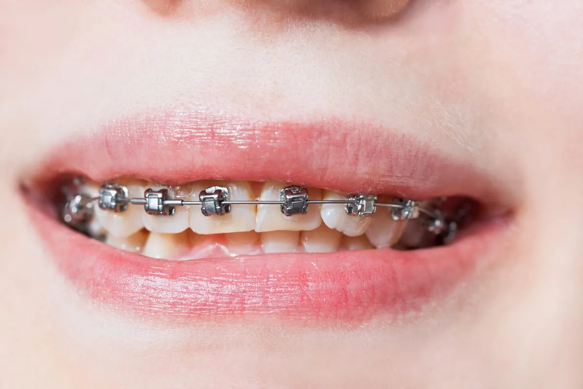 Braces Choices Widen: What Self-Ligating Braces Singapore Clinics Are Adding